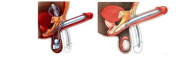 penis enlargement prosthesis