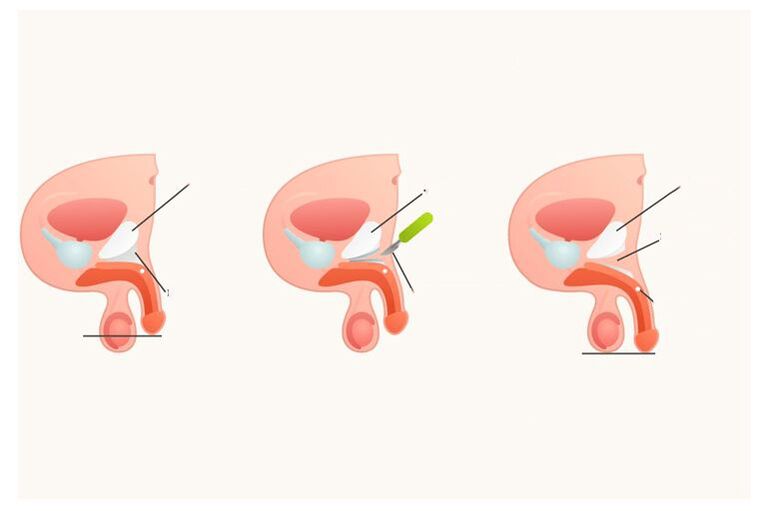 How penis enlargement surgery is performed